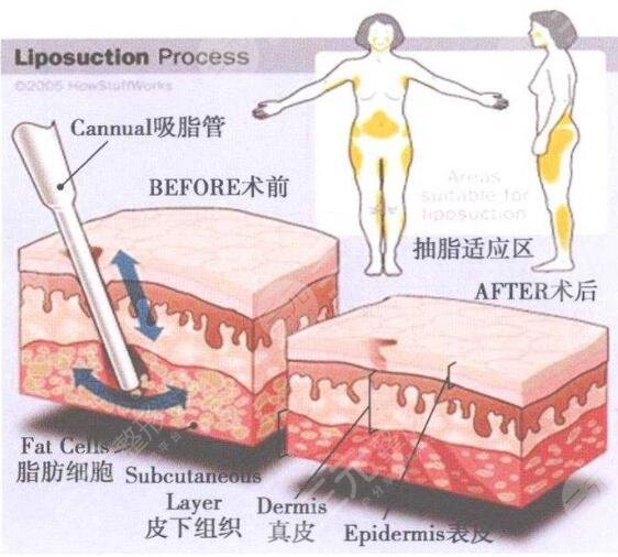 抽脂新技术，重塑身材的革命性途径