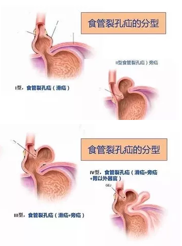 全国疝气治疗技术革新与进步，最新治疗技术引领潮流