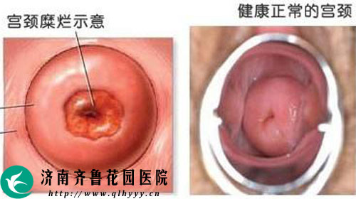 宫颈糜烂最新治疗方法概述